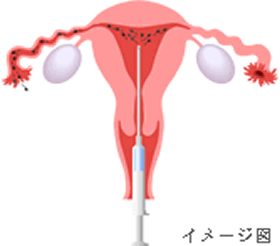 人工授精 イメージ図